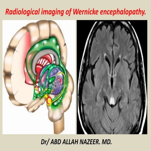 Presentation1, radiological imaging of wernicke encephalopathy.