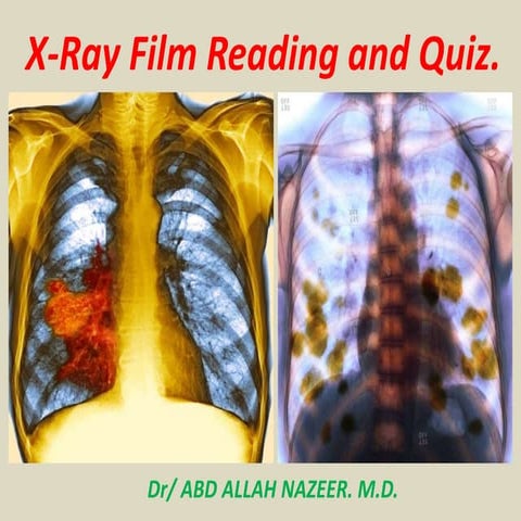 Presentation1, x ray film reading of the chest.