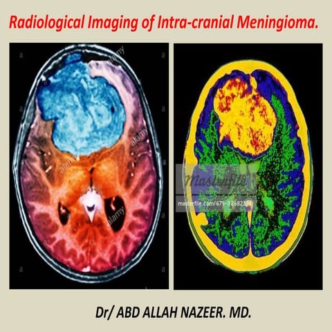 Presentation2, radiological imaging of intra cranial meningioma.