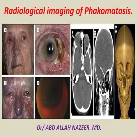 Presentation2, radiological imaging of phakomatosis.
