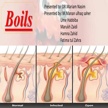 Boils | PPTX