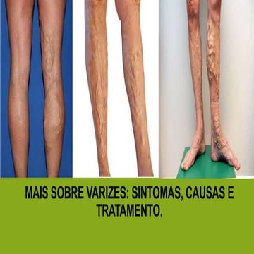 Mais sobre Varizes: sintomas, causas e tratamento.