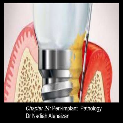 Peri-implant Diseases Classification, Cases Definition and Treatment.pdf
