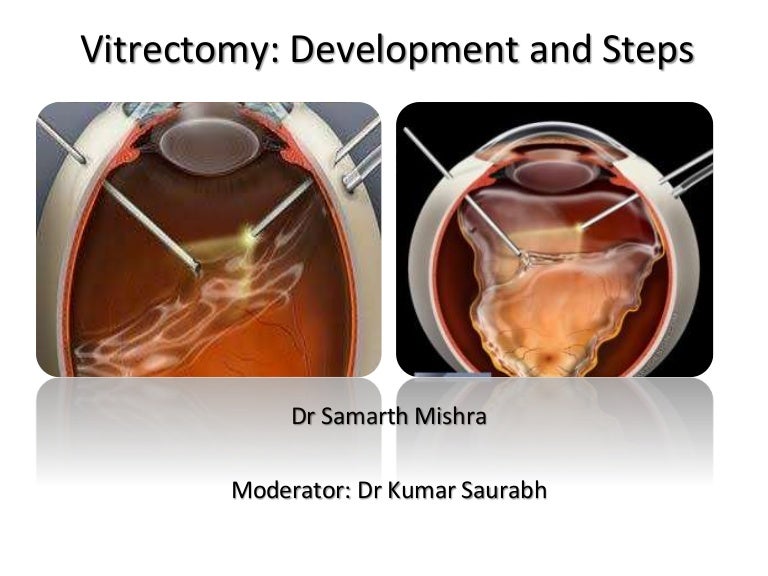 Vitrectomy Development And Steps