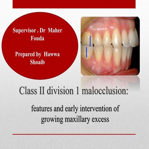 Class II division 1 malocclusion 