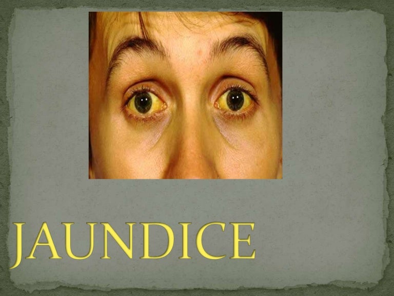 ppt jaundice and it's homeopathic management