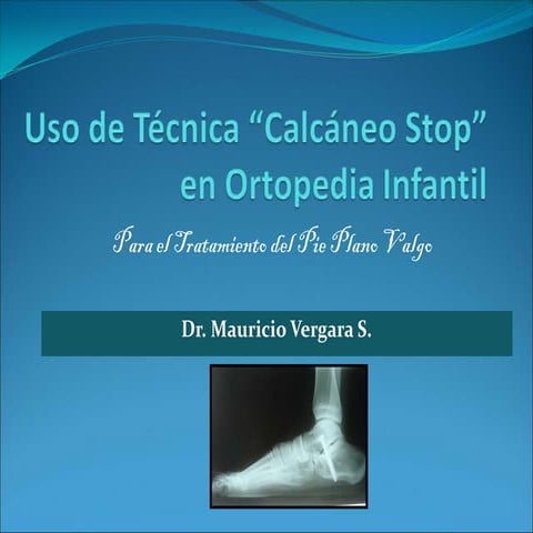 Calcaneo Stop | PDF