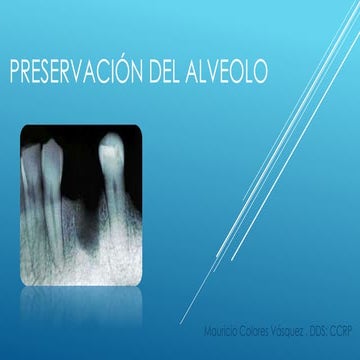 exodoncia-con-preservaci-n-alveolar1-pdf