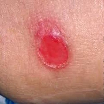 PRESSURE SORE.pptx Ms. Shweta Singh.......