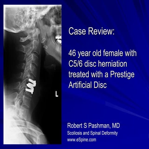 Case Review #2: 46 year old female with Prestige Disc Replacement | PDF