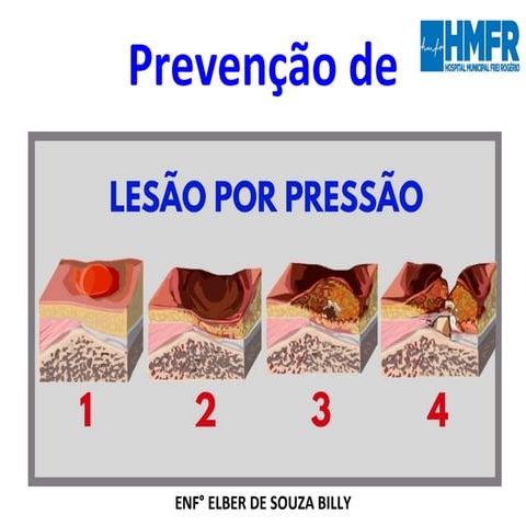 LESÃO POR PRESSÃO E CURATIVOS.pptx