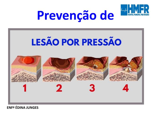 Prevenção de lesão por pressão (LPP).pptx