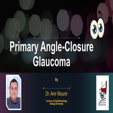 Primary angle closure glaucoma