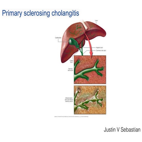 Primary sclerosing cholangitis