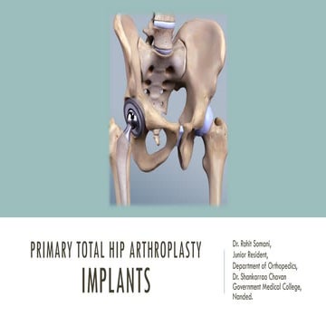 Primary total hip arthroplasty - IMPLANTS