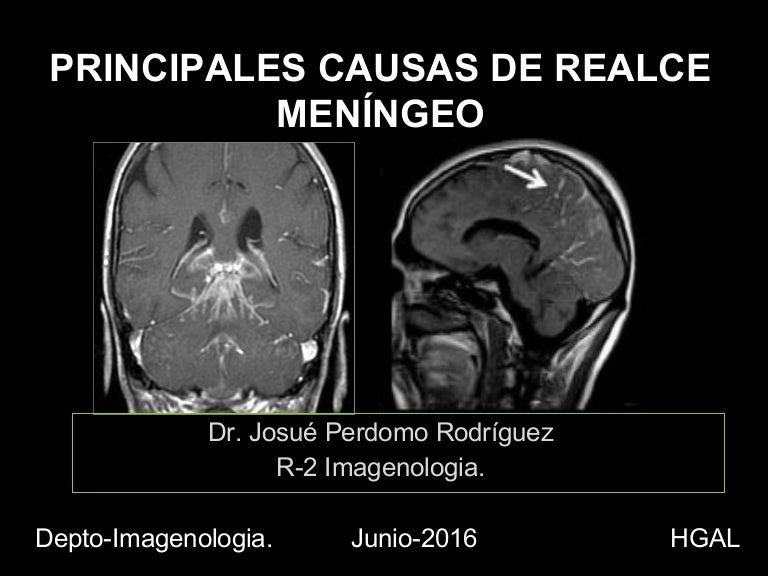 Hallazgos benignos de la hipertensión intracraneal por resonancia magnética