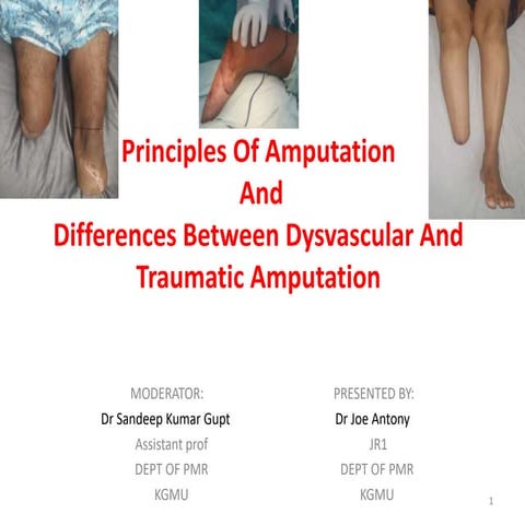Principles Of  Amputation