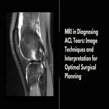 Pristyn Care - MRI in Diagnosing ACL Tears Image Techniques and Interpretatio...