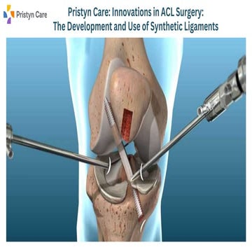 Pristyn Care Innovations in ACL Surgery The Development and Use of Synthetic ...
