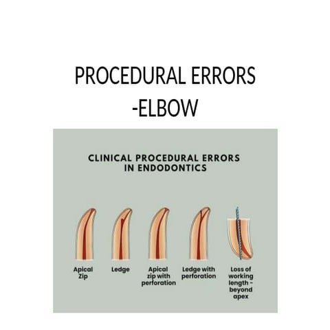 Comprehensive Overview of Procedural Errors in Endodontic Therapy ...