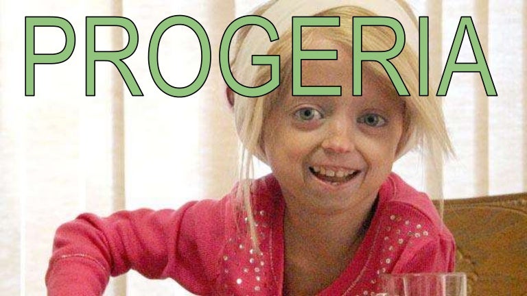 Progeria