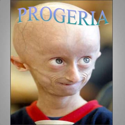 Progeria | PPT