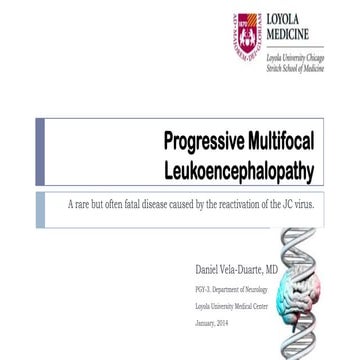 Progressive multifocal leukoencephalopathy