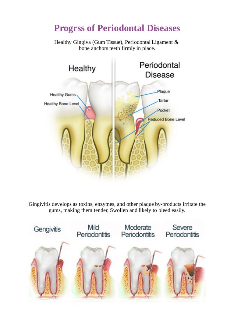 General Gum Diseases Process of Periodontal Diseases