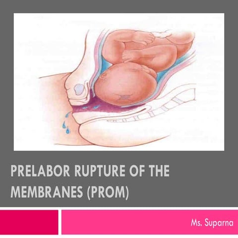 Premature rupture of membranes (PROM) | PPTX