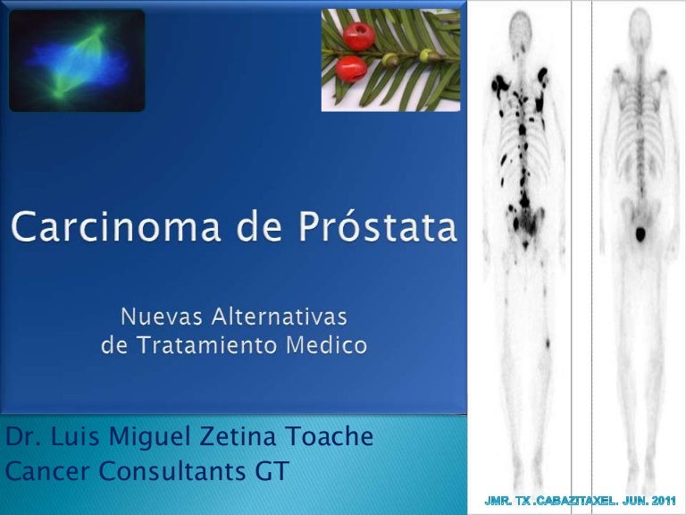 dolor óseo asociado con cáncer de próstata