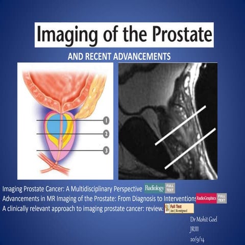 Prostate carcinoma raiology