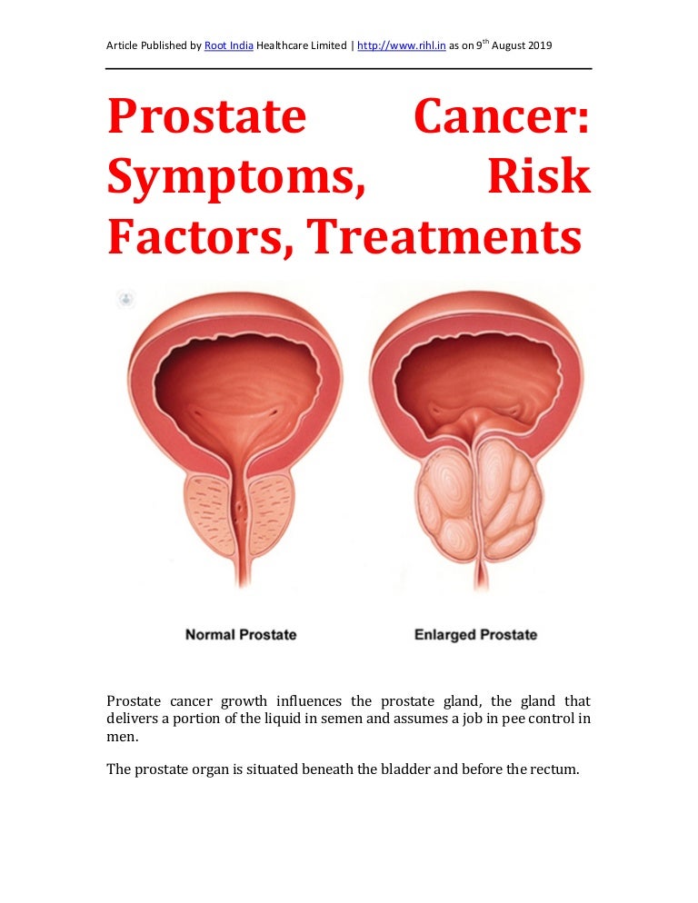 What Causes Prostate Cancer And What Are The Risk Factors? – OJVZ