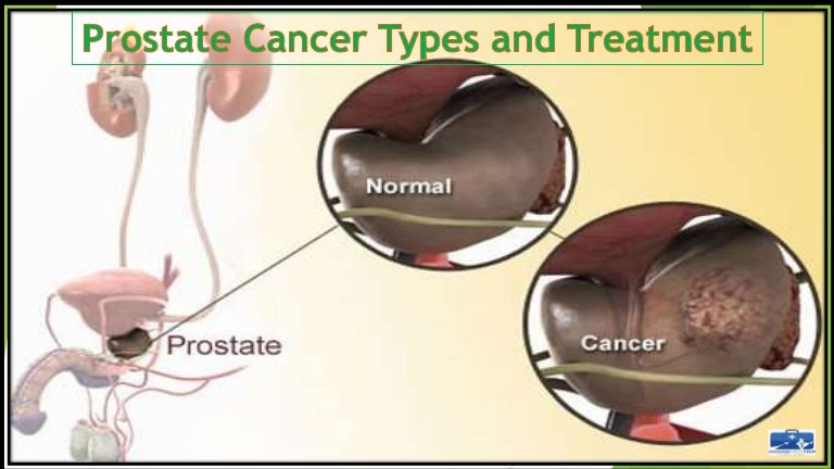Prostate cancer symptoms, types & treatment