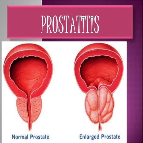 Prostatitis | PPTX