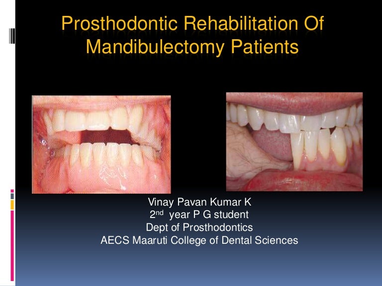 Prosthodontic rehabilitation of mandibulectomy