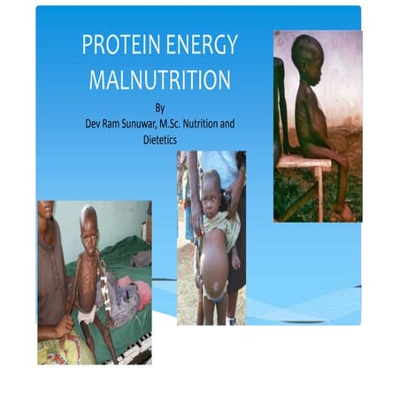 Protein energy malnutrition