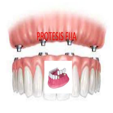 Protesis fija