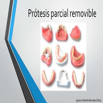 Prótesis parcial removible | PPTX