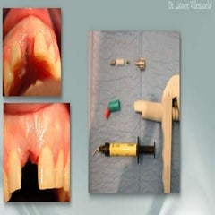 Customized provisional crown
