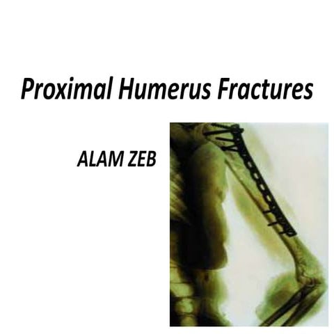 Proximal humerus fractures by amir