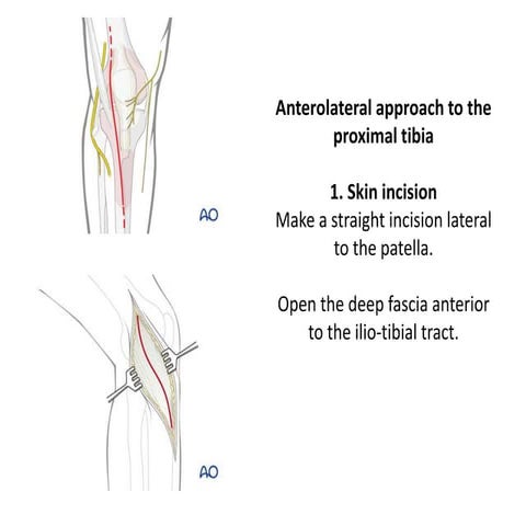 proximal tibia approach.pptx