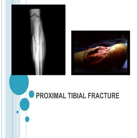 Proximal tibia fracture