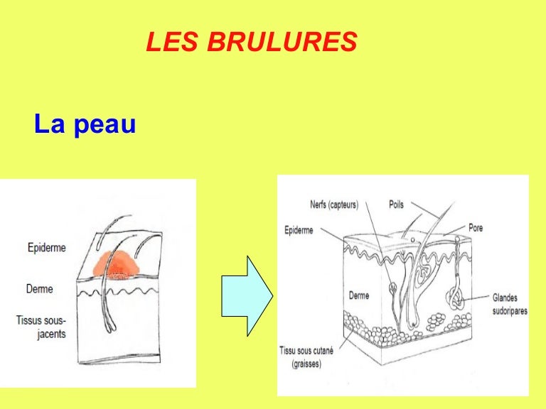 Présentation brûlures