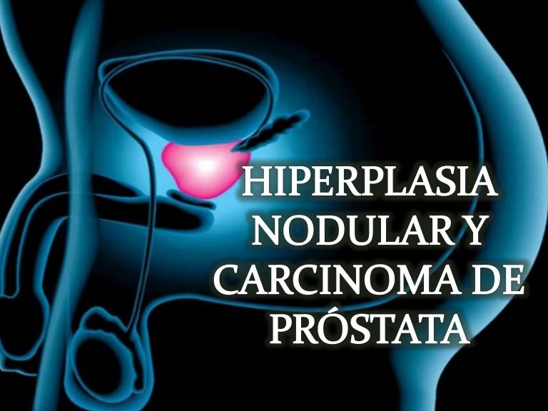 adenocarcinoma de próstata acinar 3 4 libre de ganglios linfáticos