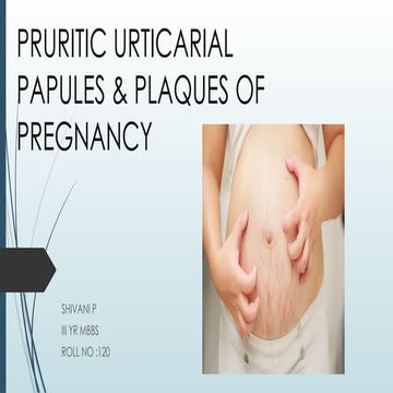 pregnancy induced pruritus,Polymorphic eruption of pregnancy,PEP ...