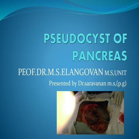 Pseudocyst of pancreas