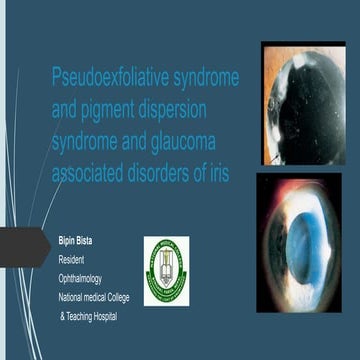 Pseudoexfoliative syndrome and pigment dispersion syndrome and glaucoma