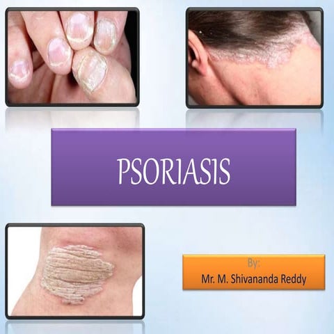 Psoriasis