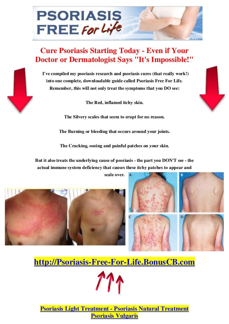 Psoriasis Light Treatment Psoriasis Natural Treatment Psoriasis V…