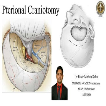 Pterional craniotomy